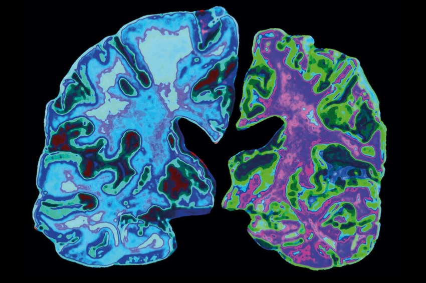 Inteligența artificială poate prezice cine se va îmbolnăvi de Alzheimer