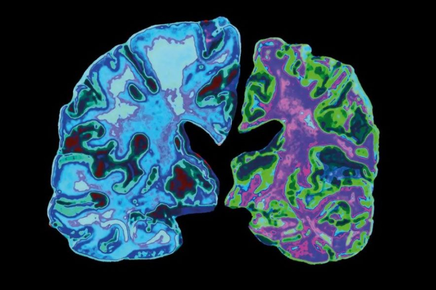 Alzheimer’s can be transmitted via bone marrow transplant